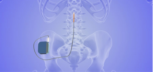 Ein Gerät in der Wirbelsäule
