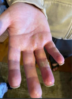 Eine rechte Hand mit CRPS